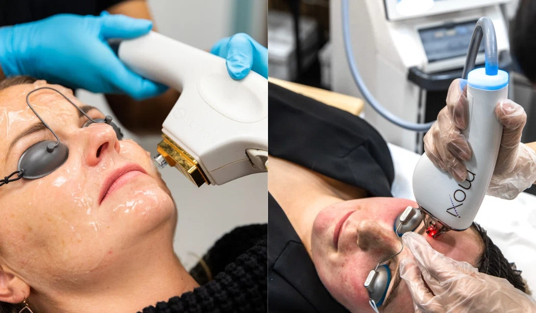 Combining Moxi and BBL for Comprehensive Skin Treatment By sarahLouise