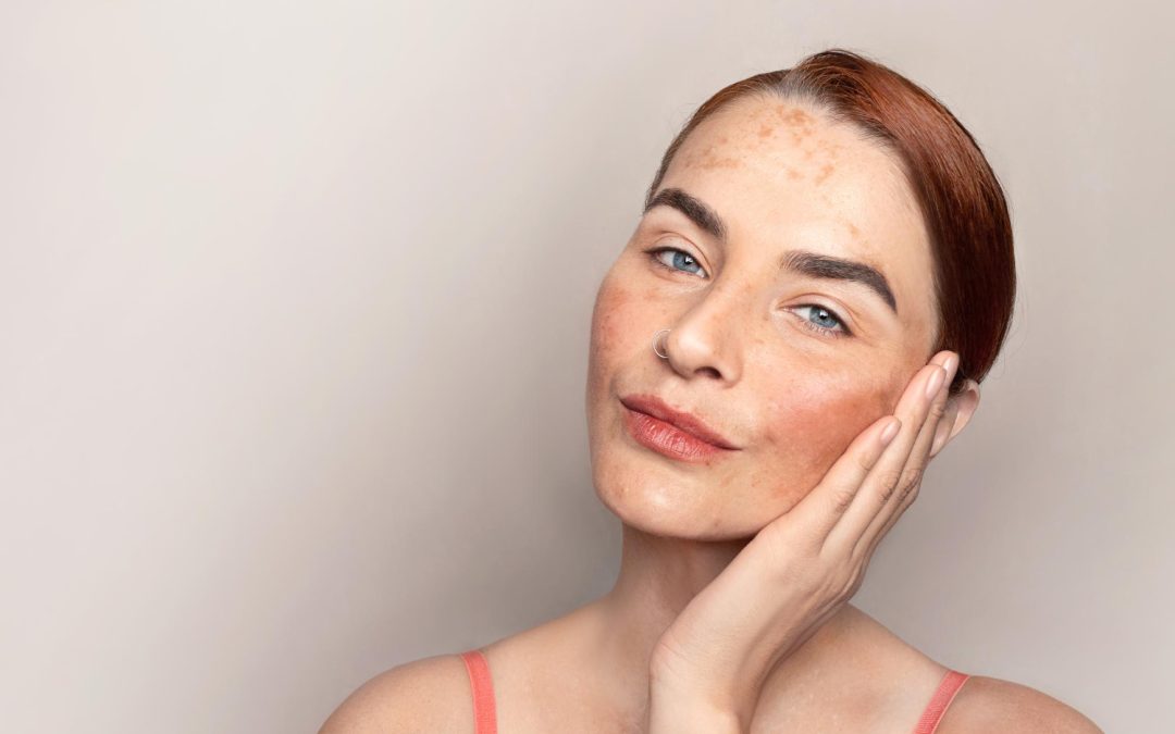 8 WAYS TO TREAT MELASMA ON THE FACE