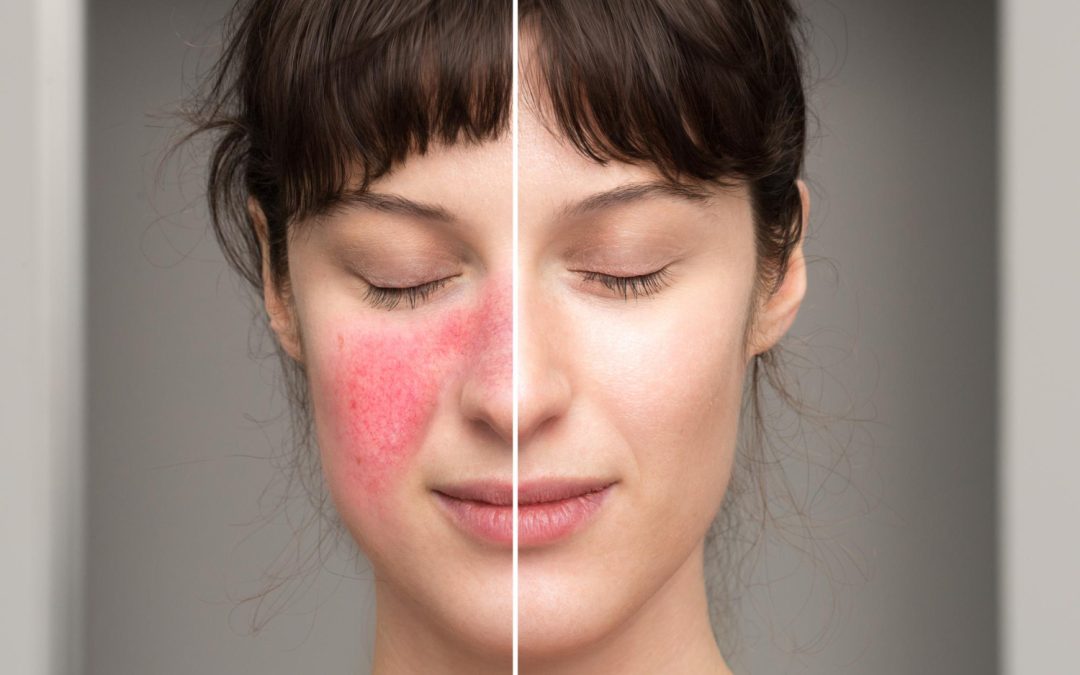 6 TIPS FOR MANAGING AND LIVING WITH ROSACEA