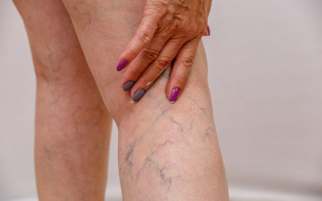 SPIDER VEIN CAUSES AND TREATMENTS