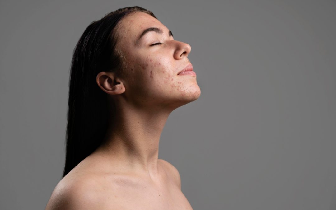 EXPERT TIPS FOR MAINTAINING SKIN HEALTH POST-ACNE TREATMENT