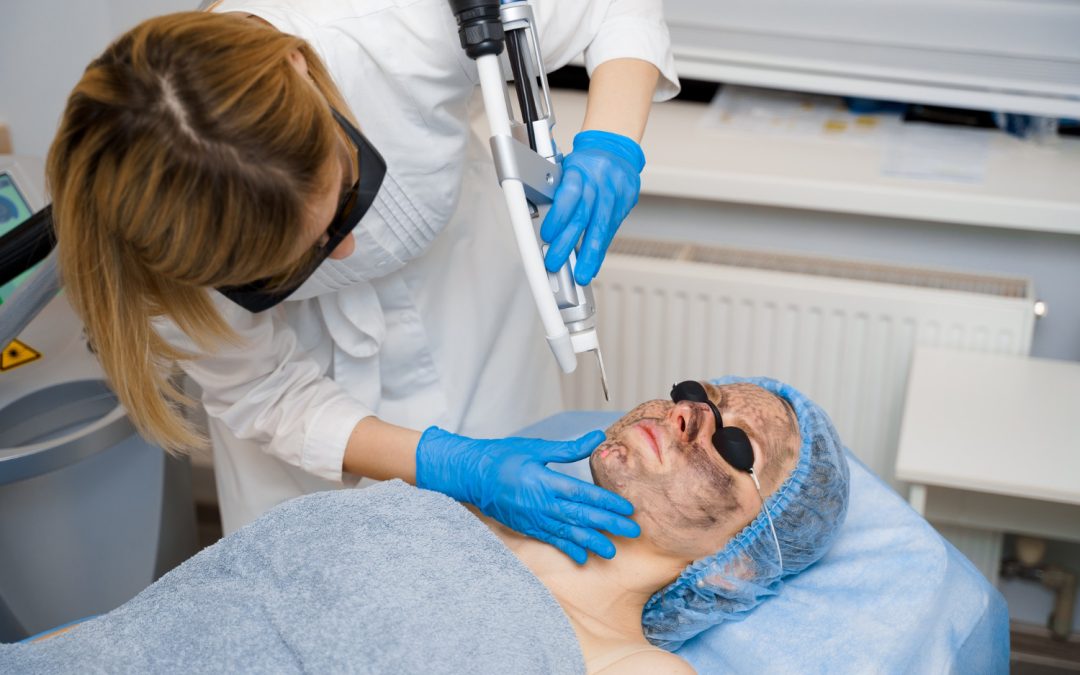 LASER FOR HYPERPIGMENTATION