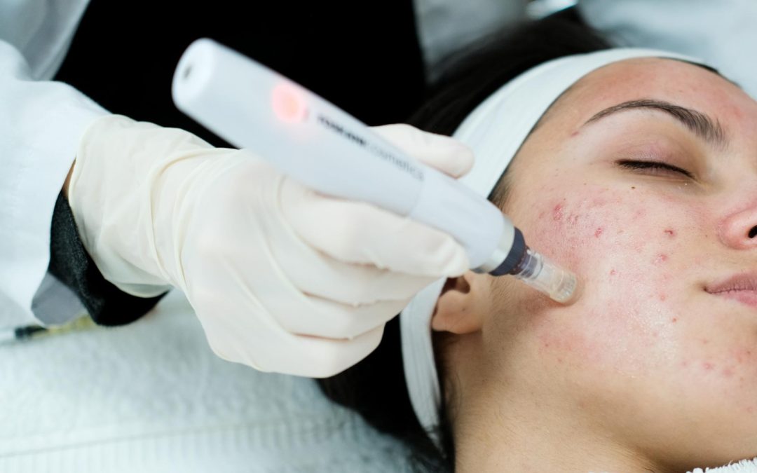 UNLOCKING THE BENEFITS OF MICRONEEDLING: THE ULTIMATE GUIDE