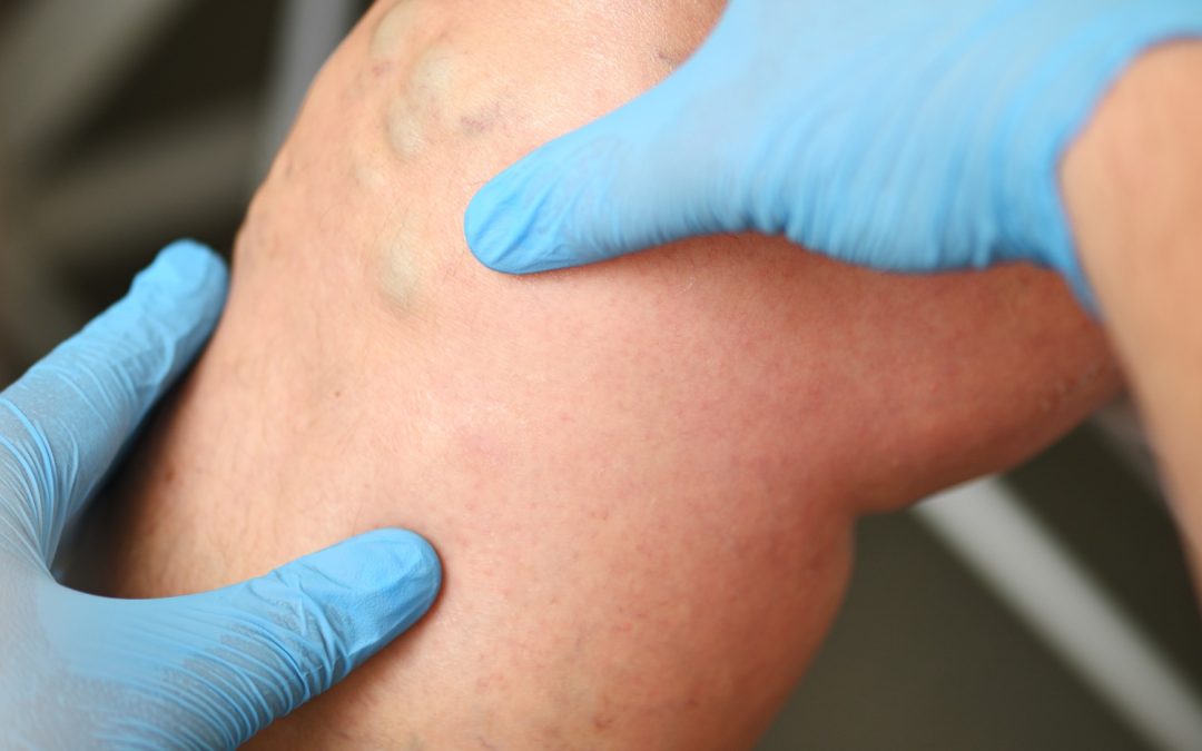 SPIDER VEINS WHAT THEY ARE AND HOW TO TREAT THEM