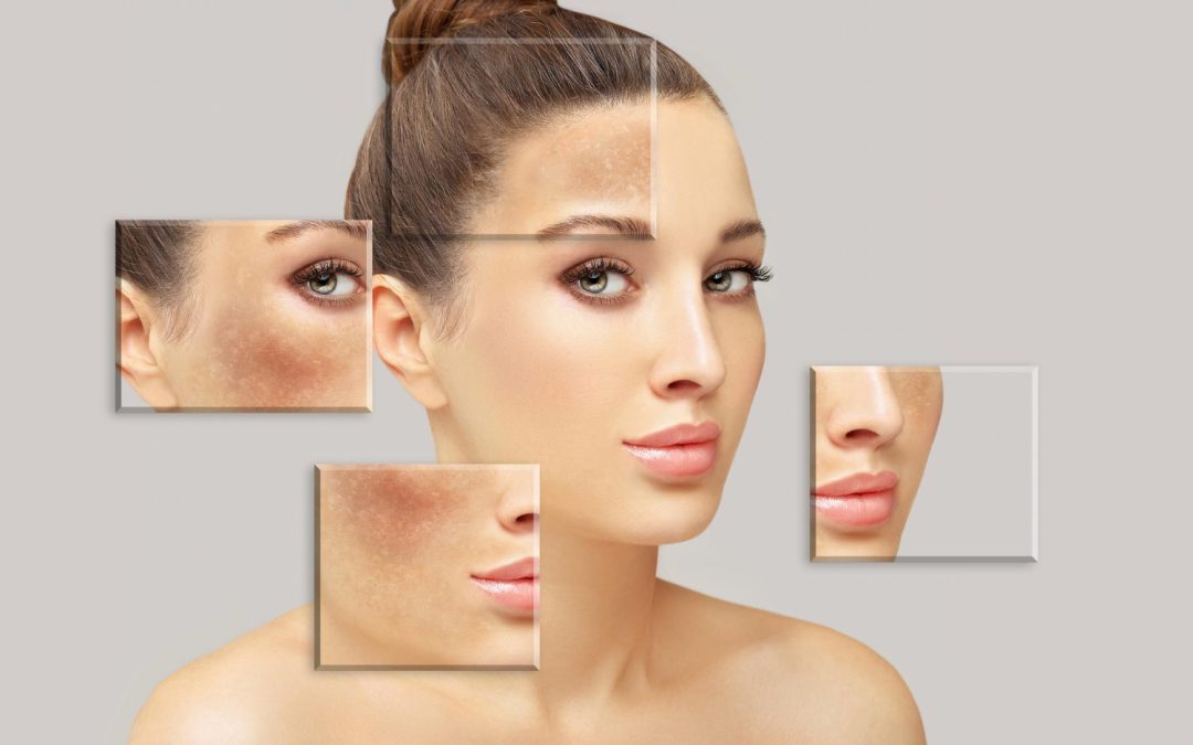 TYPES OF MELASMA AND THE BEST TREATMENTS FOR EACH