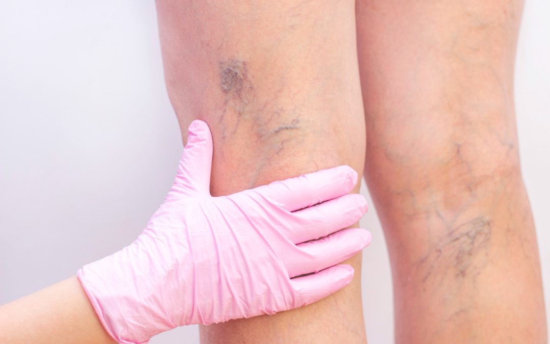 What to Expect After Spider Vein Removal A Complete Guide