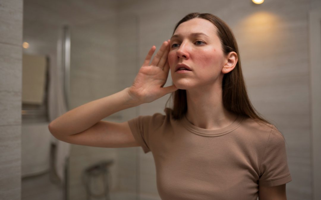 Your Guide to Rosacea