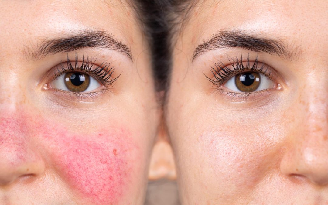 A COMPLETE OVERVIEW OF UNDERSTANDING AND HANDLING ROSACEA IN MANCHESTER