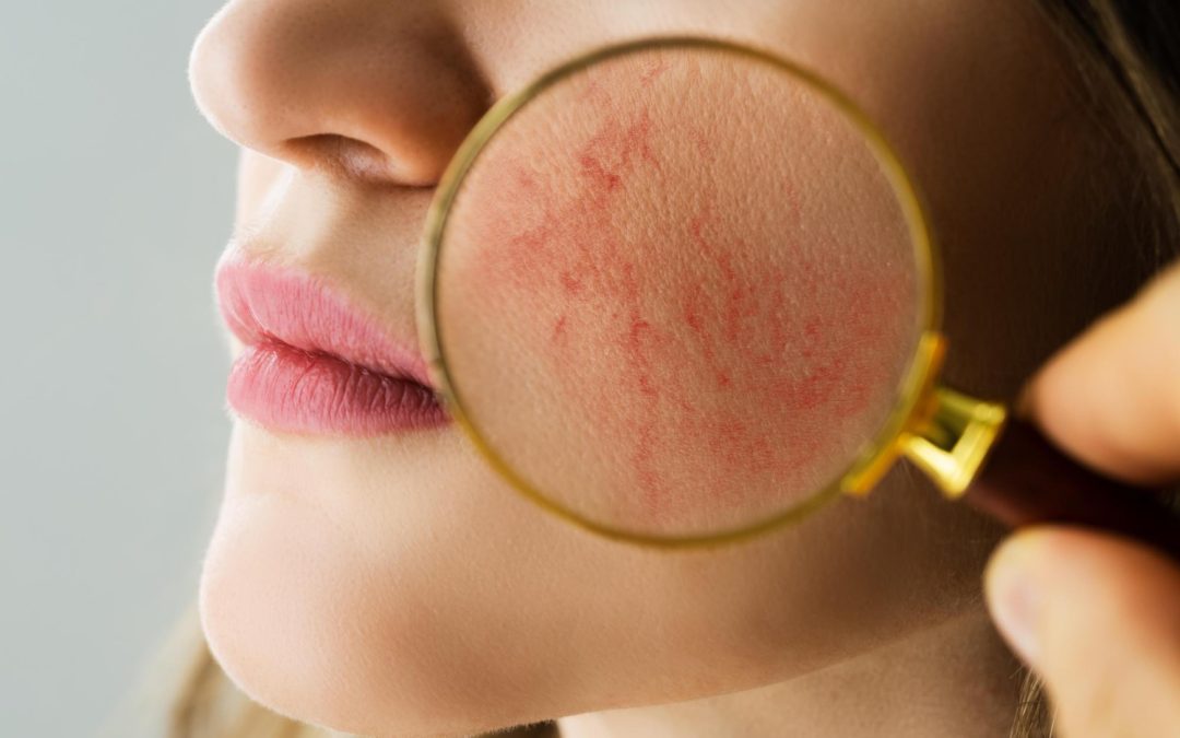 Rosacea Skin Care: SLA Medical Clinic Dermatologist’s Guide to Treatment