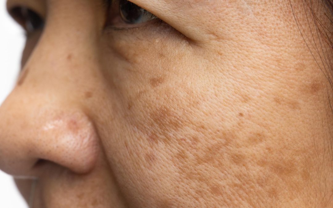 A Guide To Understanding And Treating Melasma In Manchester