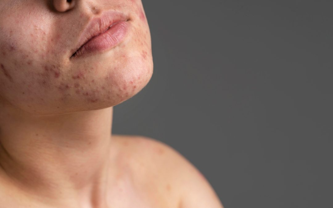 Hormonal Acne In Adult Women