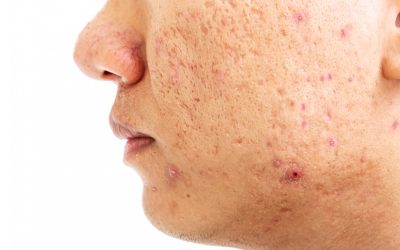 How SLA Medical Clinic In Manchester Tackles Persistent And Severe Acne