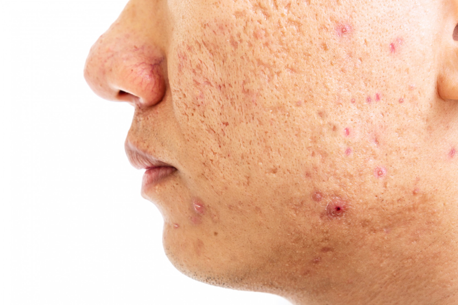 How SLA Medical Clinic In Manchester Tackles Persistent And Severe Acne