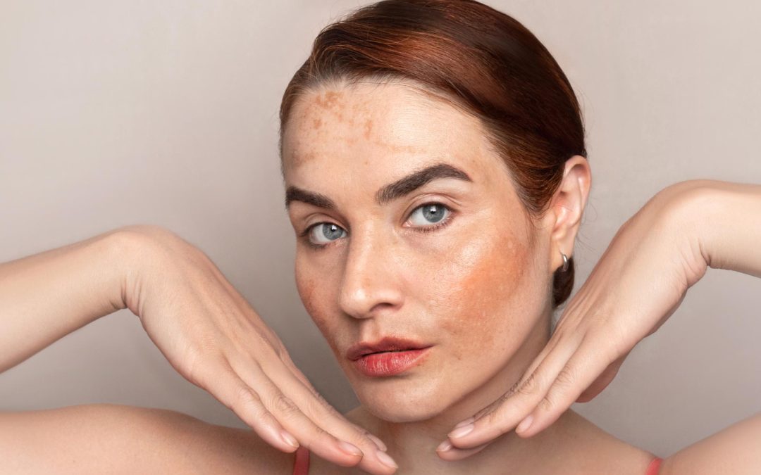 Pigmentation is Not All The Same